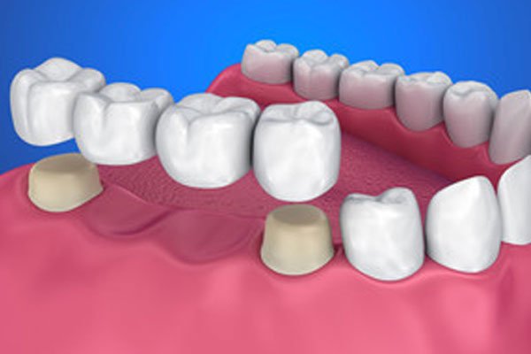 Seattle SmileWorks Seattle Family Dentist Porcelain Fixed Bridges Procedures