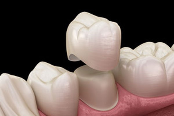 Seattle SmileWorks Seattle Family Dentist Porcelain Crowns Caps Procedures