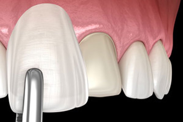 Seattle SmileWorks Seattle Family Dentist Porcelain Veneers Procedures