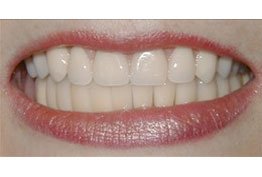 Seattle SmileWorks Smile Gallery - Dental Implants